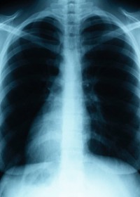 Lung Cancer Therapy 