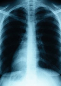 Lung Cancer 