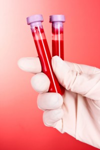 Tests Have Found Blood Can Help Identify Signs of Pancreatic Cancer.