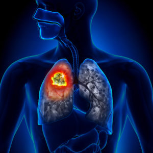 Find Out Why Lung Cancer is the Deadliest Cancer