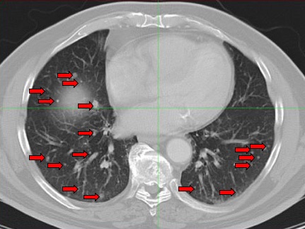  Pretherapy CT scan of Chest: Innumerable nodules are seen in bilateral lung fields consistent with metastatic melanoma.