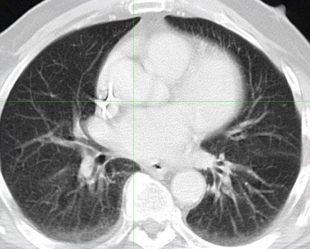 Image 2. Post-therapy CT scan of chest performed 4 weeks after treatment. Images reveal resolution of all previously seen lung nodules suggesting complete response to treatment.