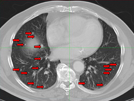 Complete Remission of Innumerable Lung Metastases from Melanoma